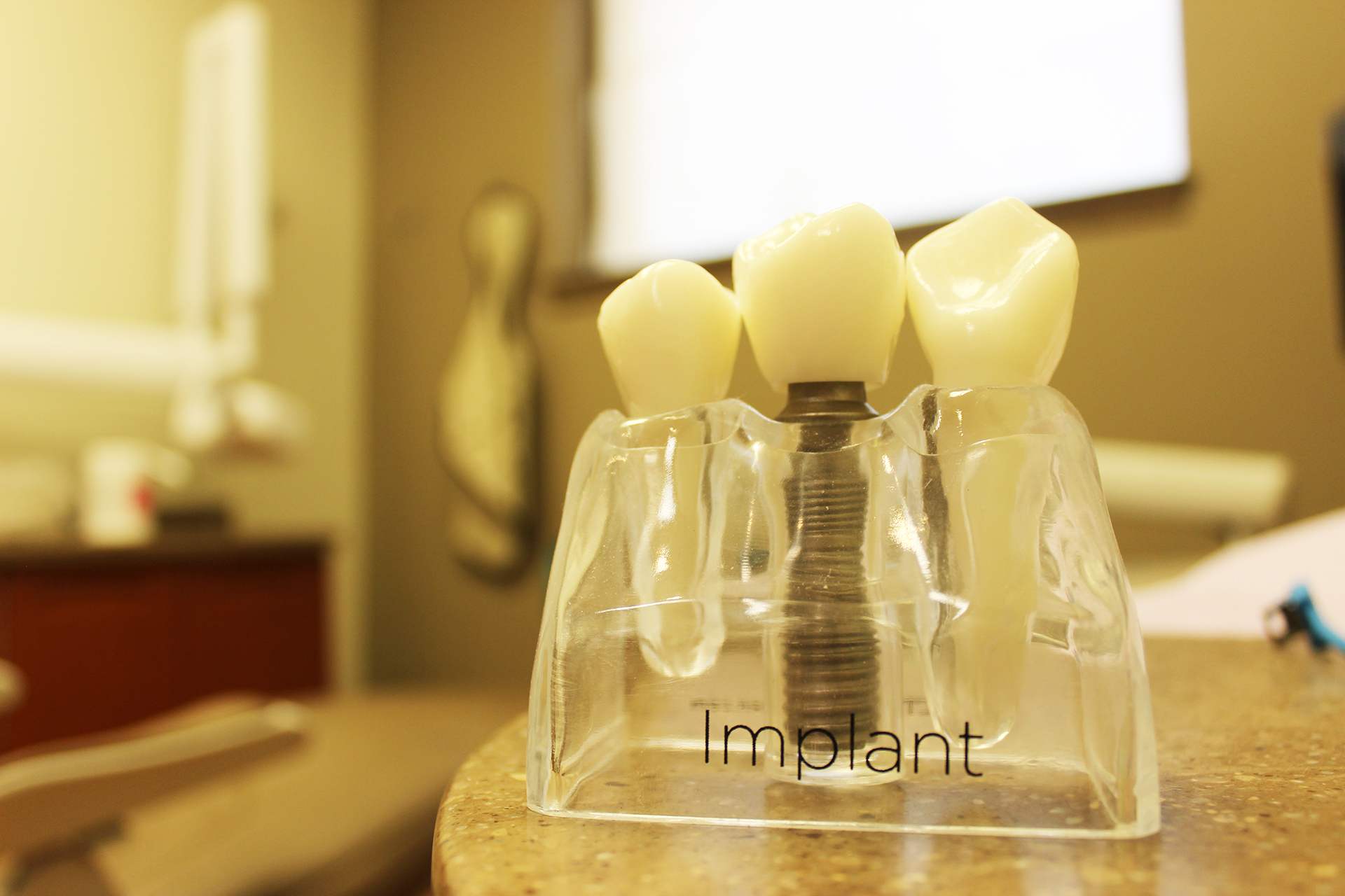 dental implant display