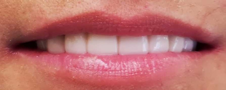 woman's mouth with straight white teeth