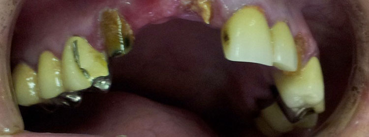 mouth with yellow broken missing teeth