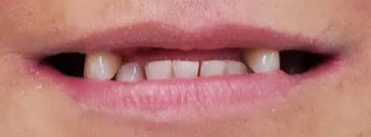 mouth with missing teeth