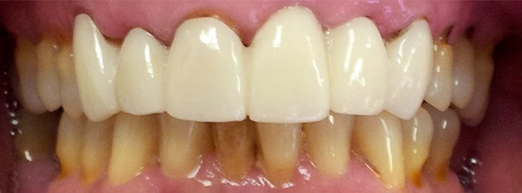 straight white teeth