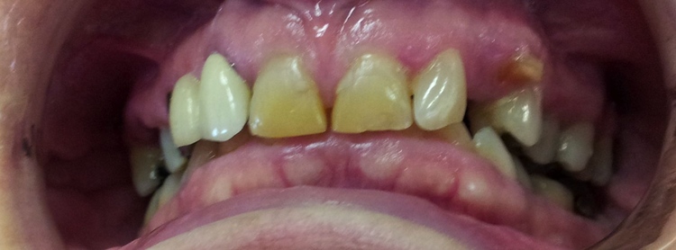mouth with missing yellow crooked teeth