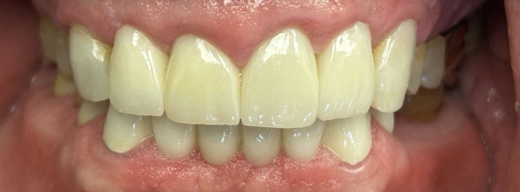 straight white clean teeth