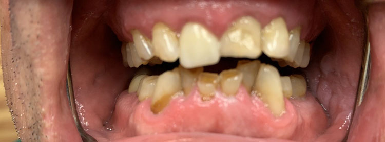 yellow broken crooked plaque teeth